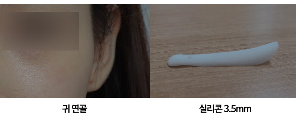 여자매부리코와 비염수술후기 관련 이미지 8