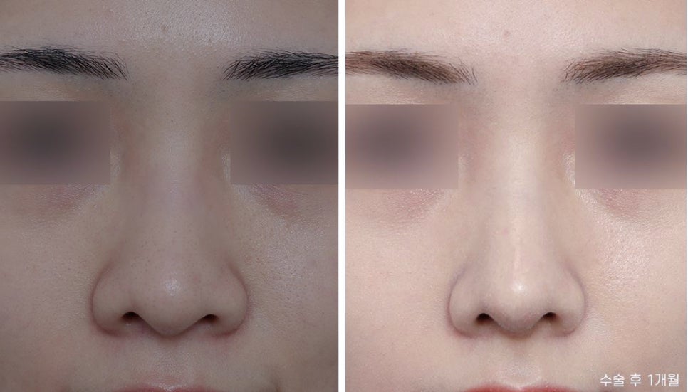 What Is the Prettiest Nose That Suits My Face Best? image 10