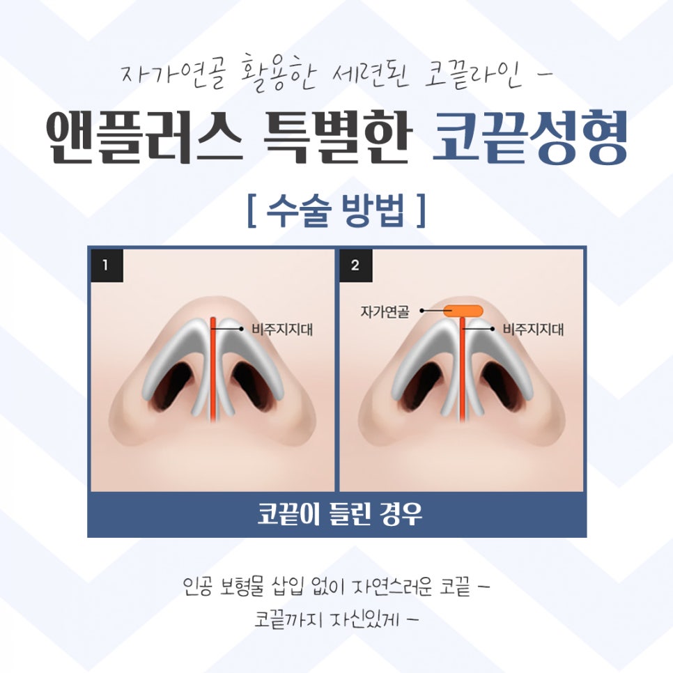 코끝성형 후기까지 확인하고 관련 이미지 9