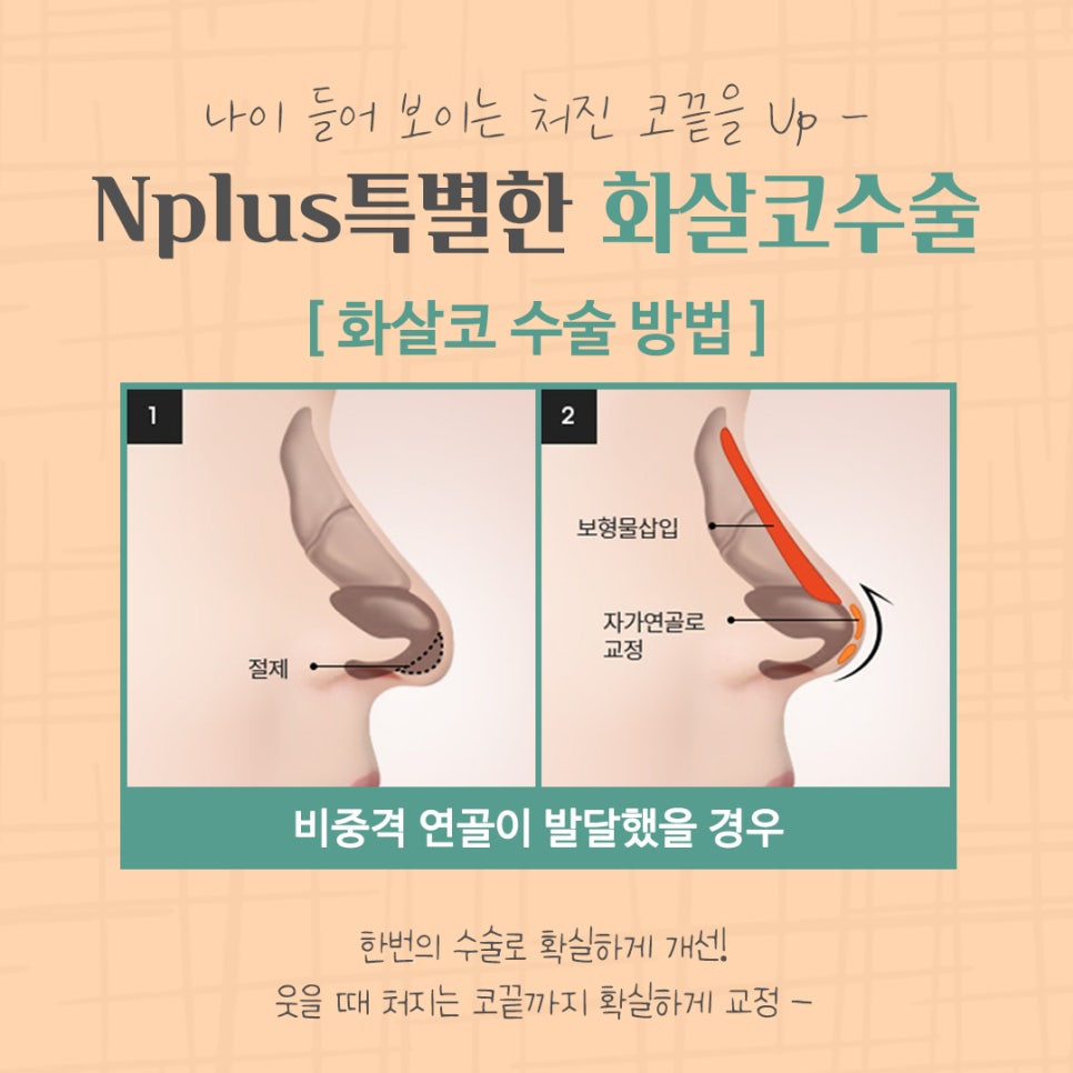 화살코수술 후기까지 알아보고 결정 관련 이미지 8