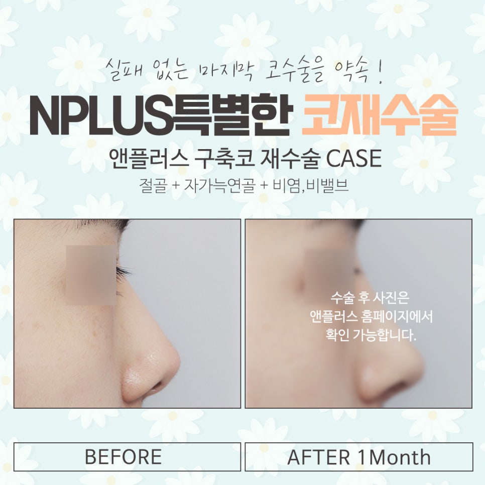 코재수술후기에 대해 자세하게 알아보고 관련 이미지 15