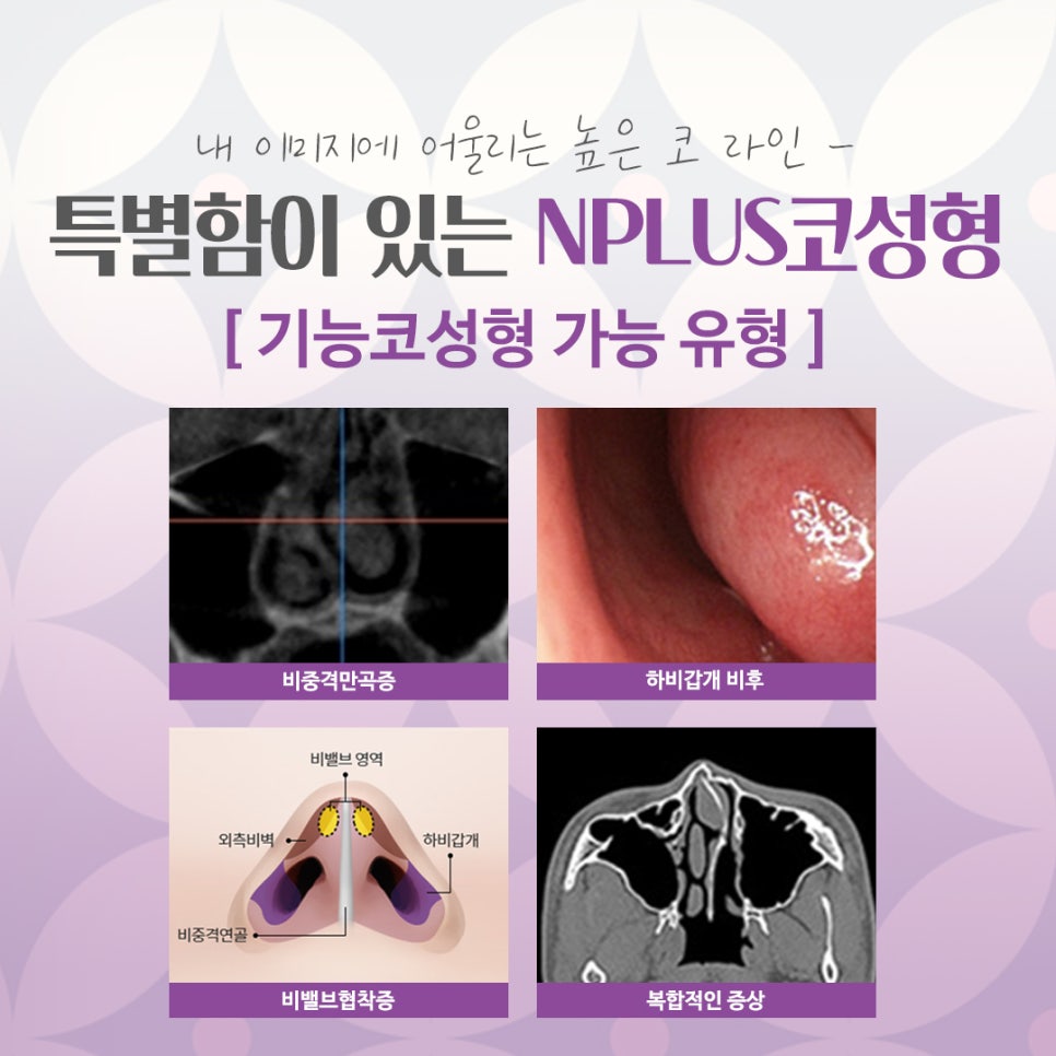 강남코수술에서 자연스럽고 예쁜 코라인! 관련 이미지 5