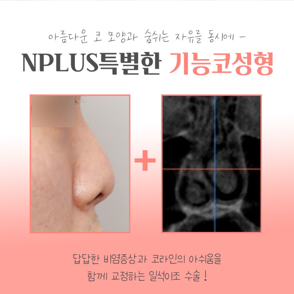 기능코성형후기 여러 가지를 비교하고 관련 이미지 4