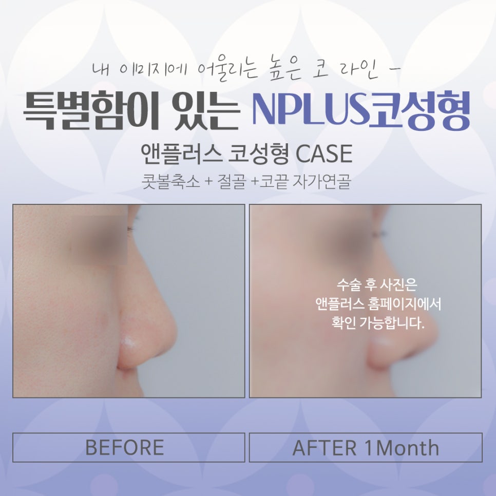 코수술잘하는곳에 대해 꼼꼼하게 체크하여 관련 이미지 14