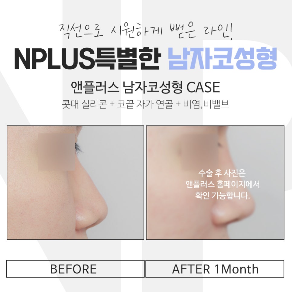 Looking into Male Nose Surgery Reviews in Detail image 13