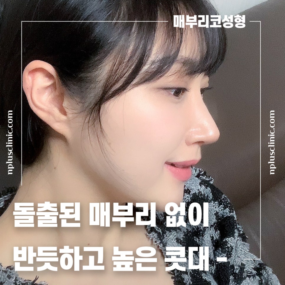 앤플러스에서 알려드리는 성형외과 가을 코수술 이벤트&hearts; 관련 이미지 4