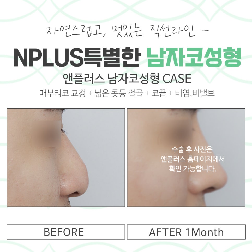 Carefully Checking Male Rhinoplasty Reviews image 14
