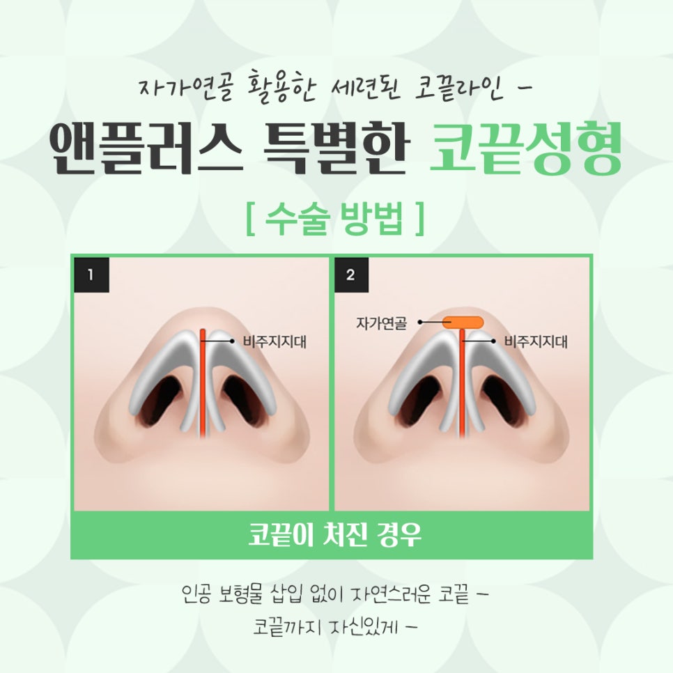 코끝수술후기 자가연골을 통해 자연스럽게 관련 이미지 8