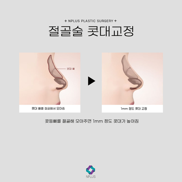 무보형물 코수술 자연스러운 코끝성형 관련 이미지 5
