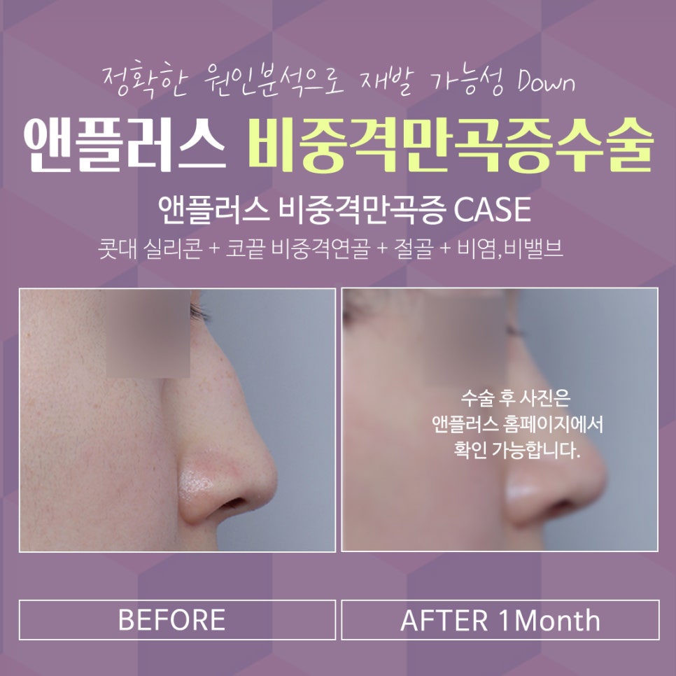 비중격만곡증수술후기 라인까지 고려해서 관련 이미지 9