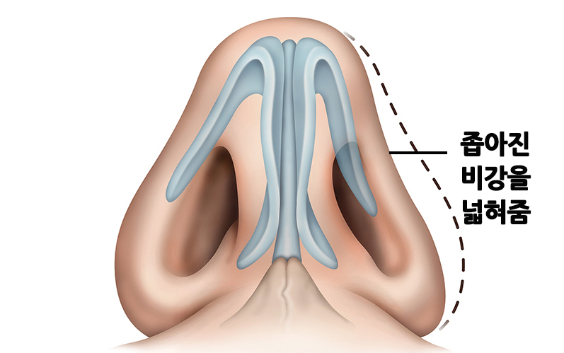 Be sure to research rhinoplasty for rhinitis before surgery! image 6
