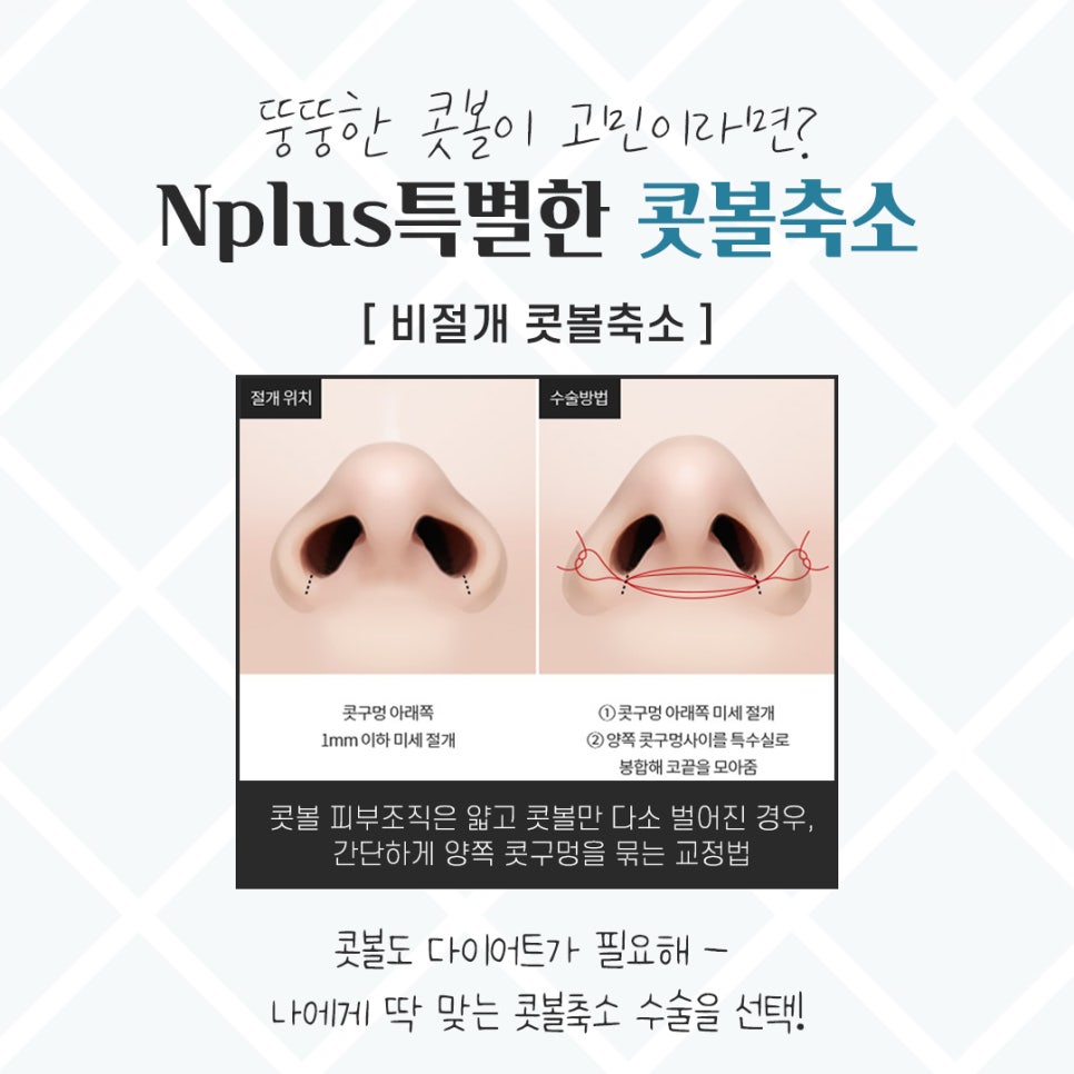 Choosing After Checking Rhinoplasty Alar Reduction Surgery Reviews image 8