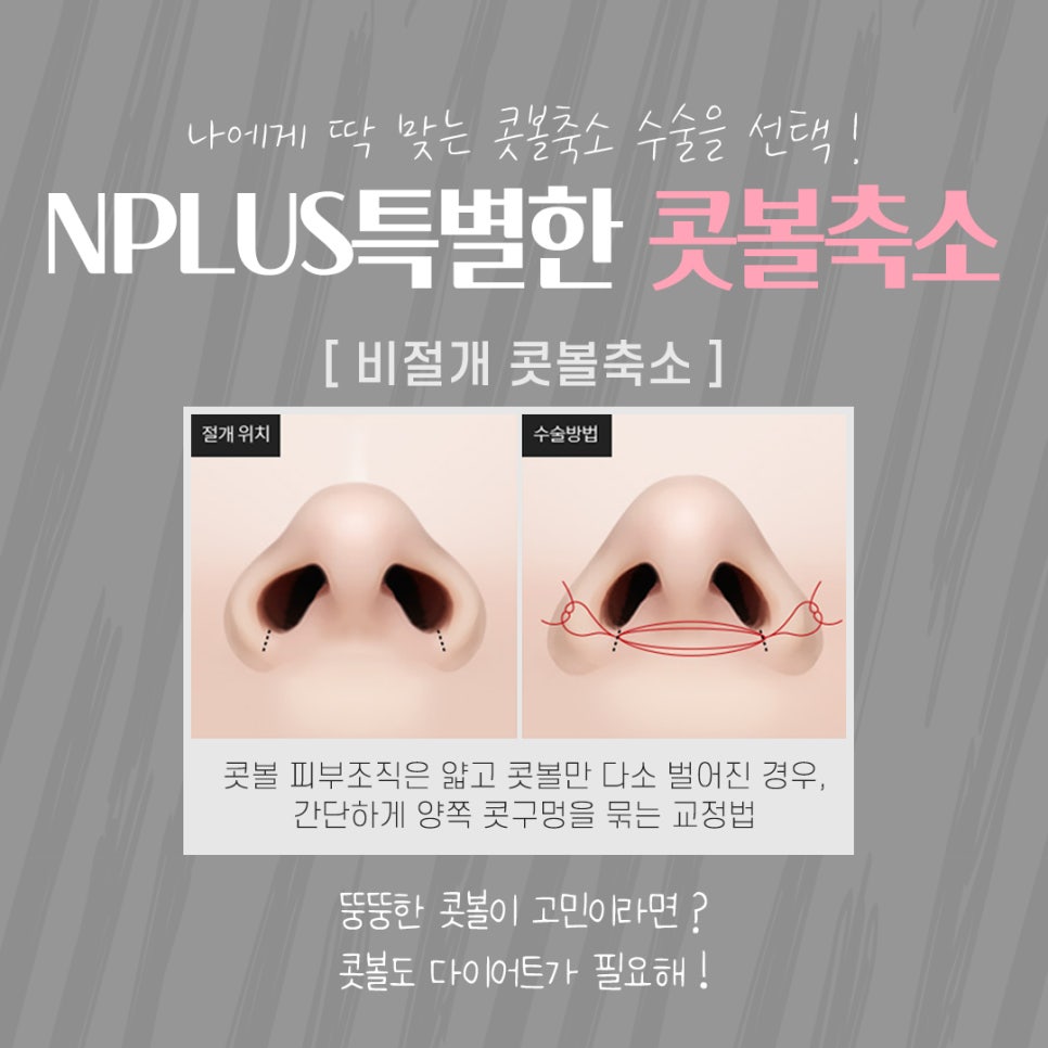 콧볼축소수술후기에 대해 알아보고 결정 관련 이미지 8