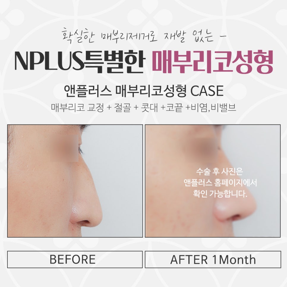 매부리코수술후기 예쁜코라인으로 관련 이미지 17