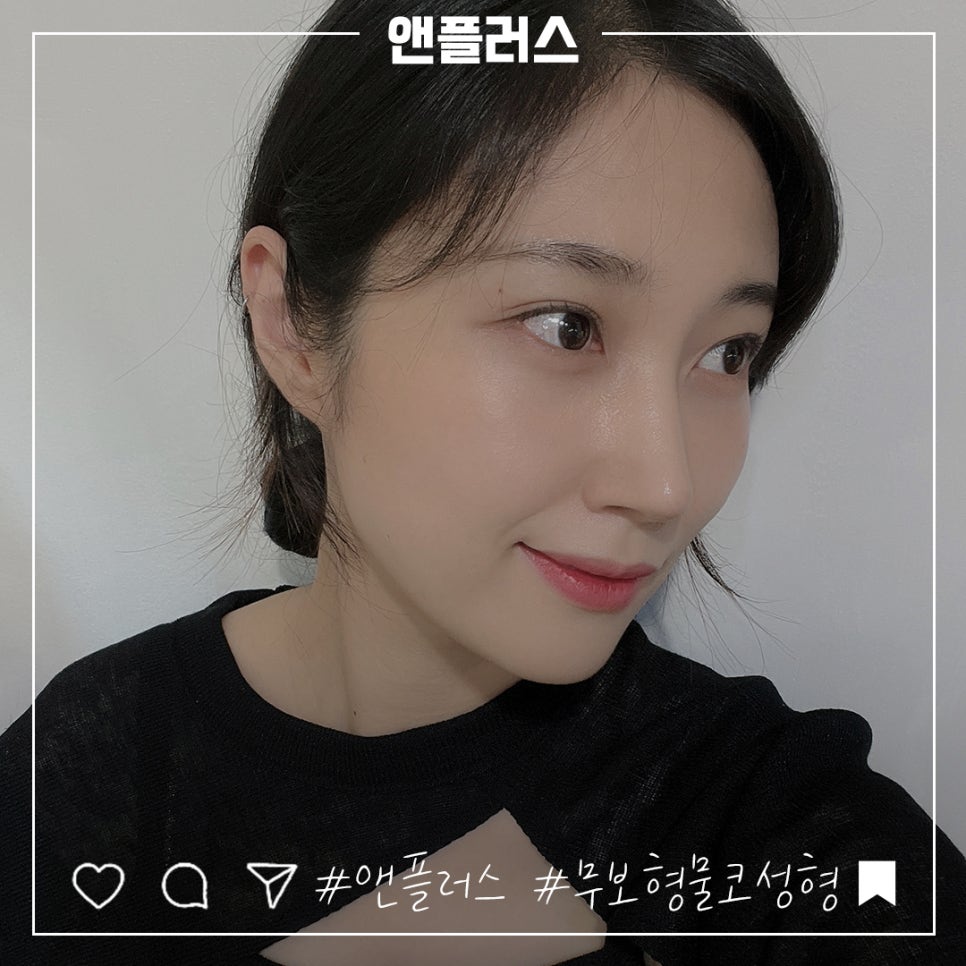 무보형물코수술을 통해 자연스러운 코라인으로 관련 이미지 10