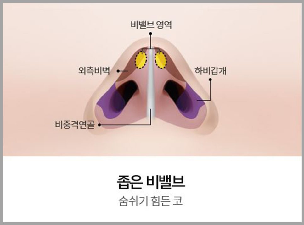 비염코성형? 어렵지 않아요. 관련 이미지 9
