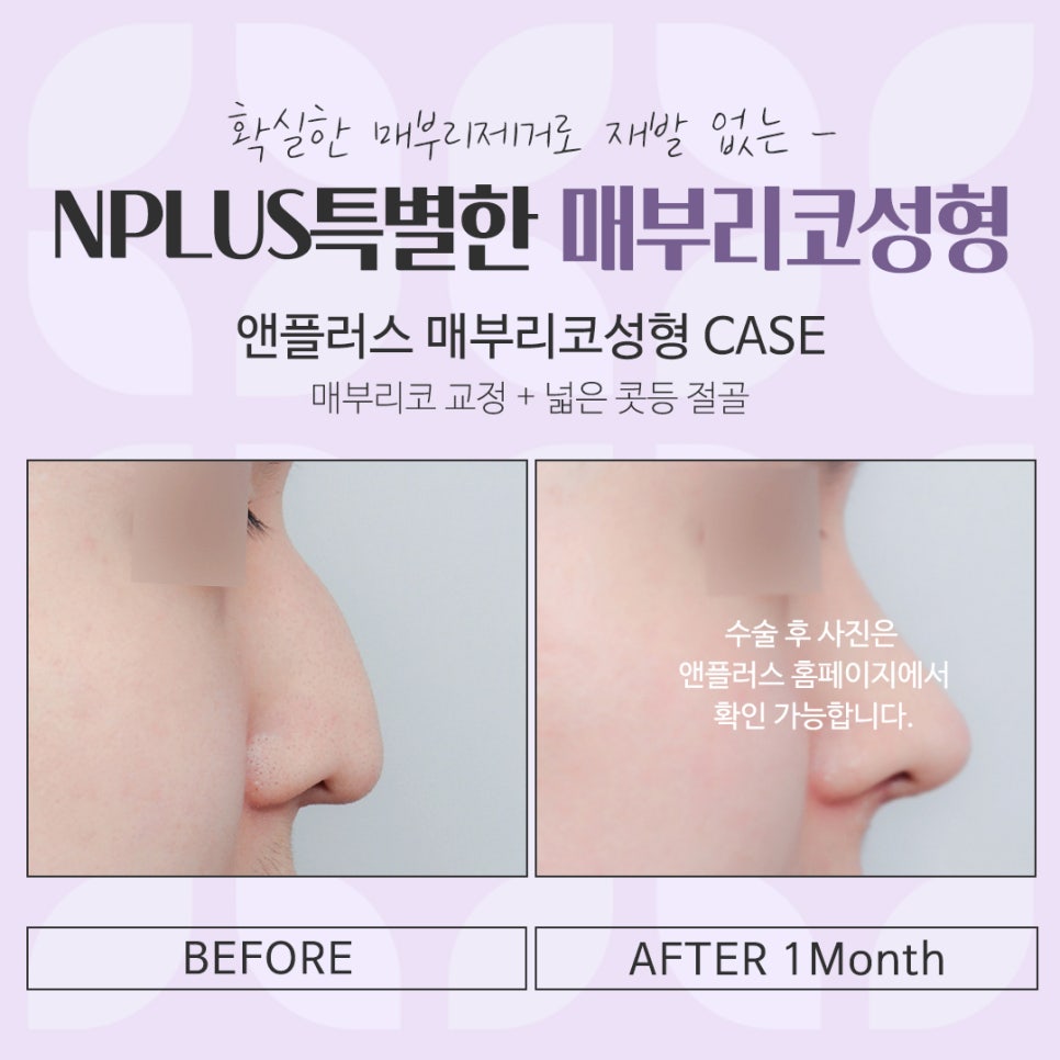 Check the Hump Nose Surgery Review in Detail image 7