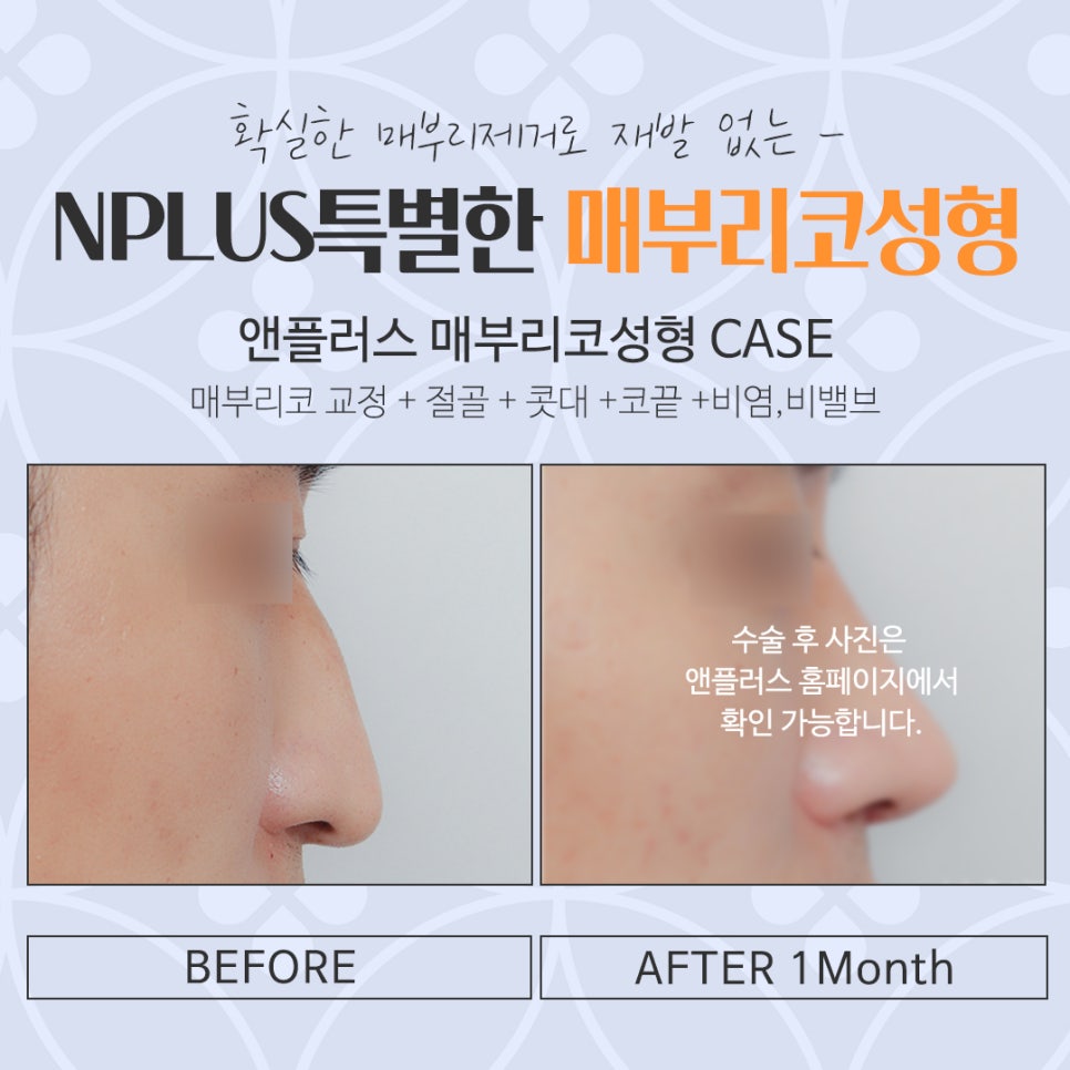 매부리코성형후기 매부리코 잘하는 곳에서 관련 이미지 17