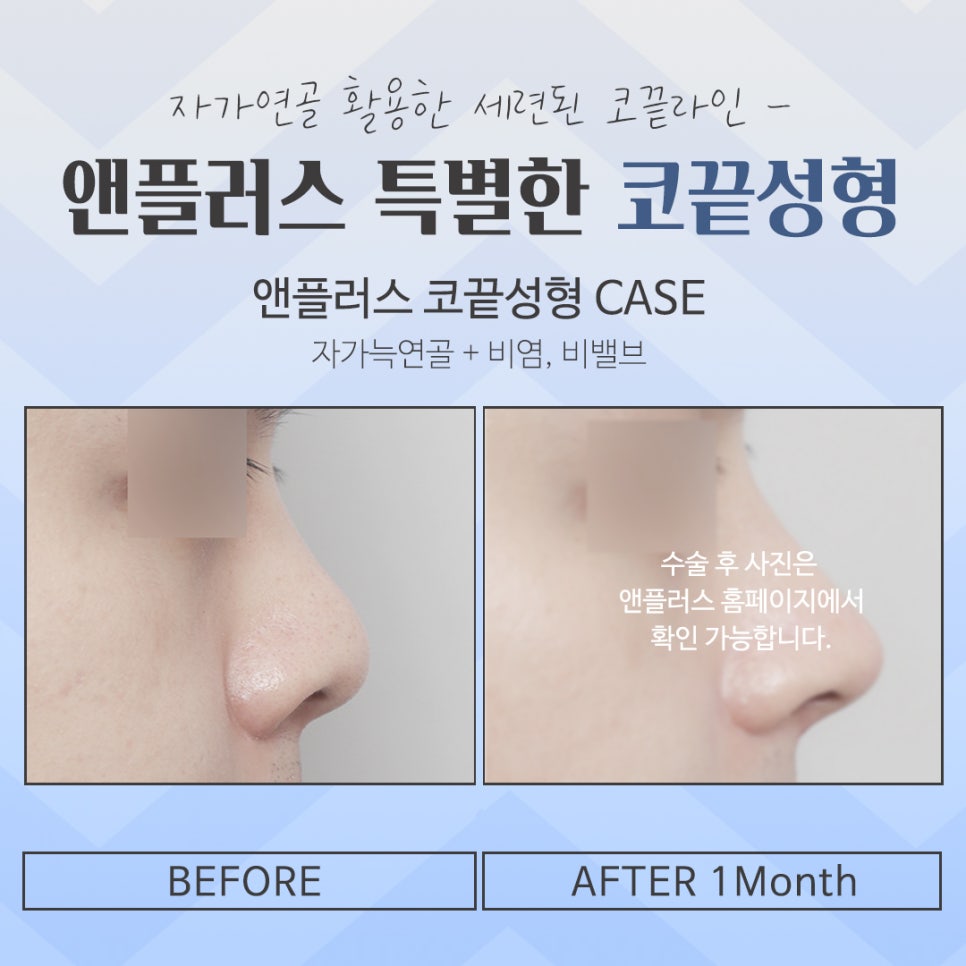 Looking into Comparisons of Tip Rhinoplasty Reviews image 14