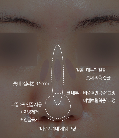 여자매부리코와 비염수술후기 관련 이미지 7