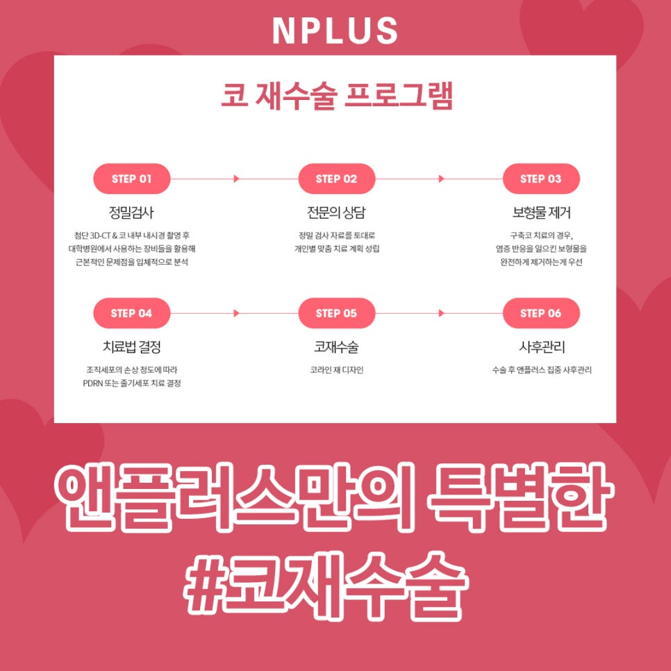 압구정성형외과_코재수술 본인 얼굴에 맞게 선택 관련 이미지 3
