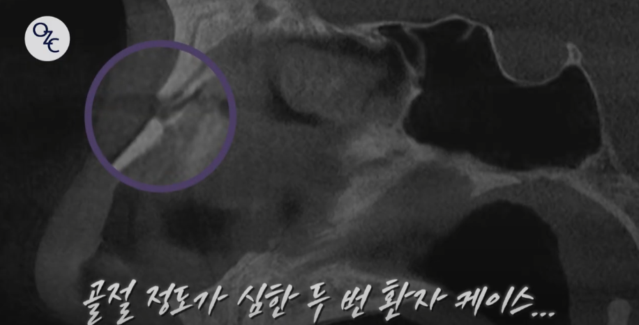 코뼈골절의 원인과 수술 방법에 대하여 관련 이미지 15