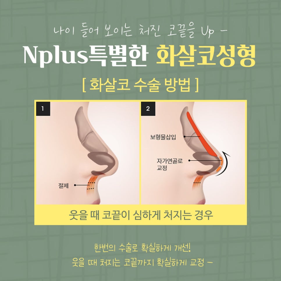 화살코성형 후기까지 확실하게 관련 이미지 11