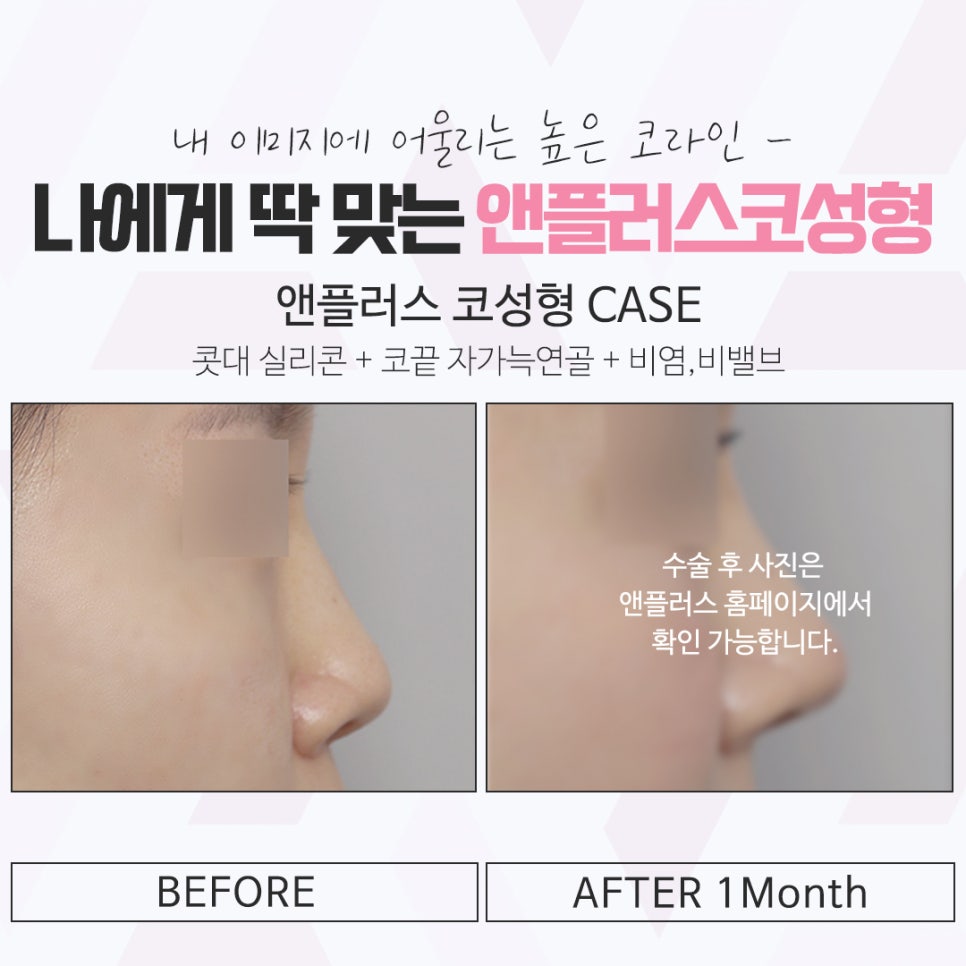 앤플러스의원에서 전해드리는 코성형후기 관련 이미지 13