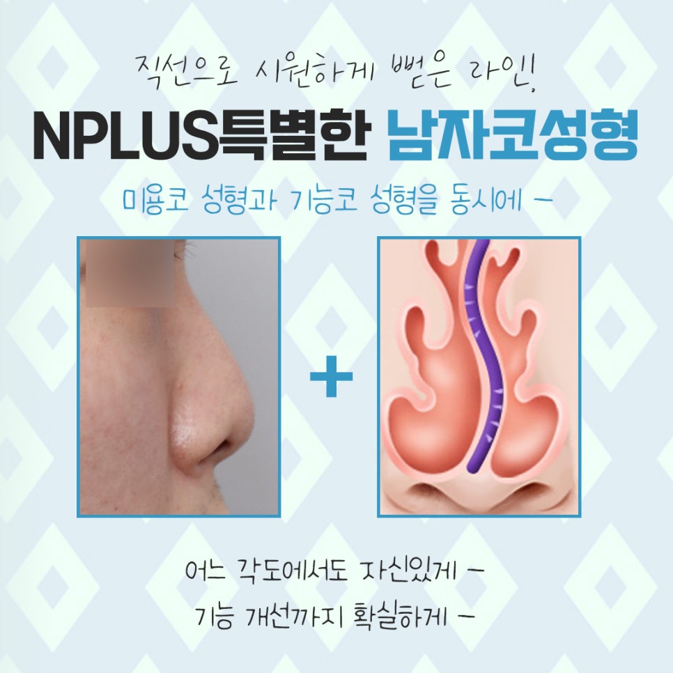 남자코수술전후 라인까지 고려하여 관련 이미지 4