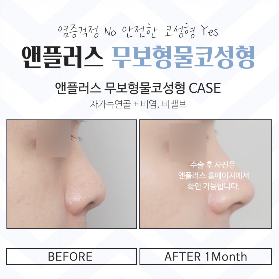 Detailed Information on Non-Implant Rhinoplasty image 14