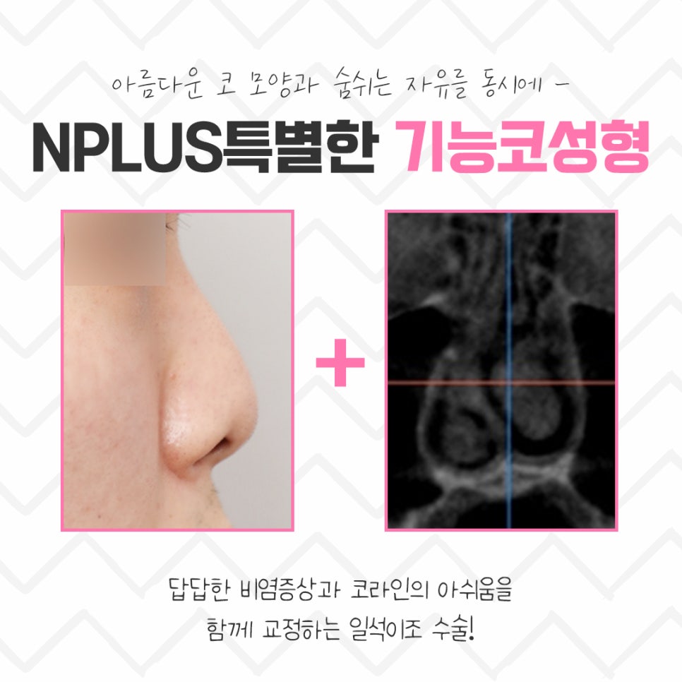 기능코수술후기 정확한 진단을 통해 관련 이미지 4