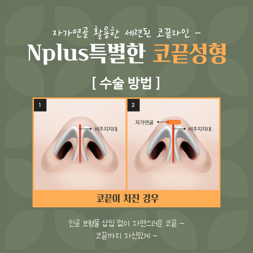 코끝성형으로 자연스럽게 예뻐지자 관련 이미지 10