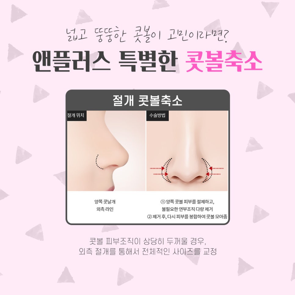If You Want to Learn About Nostril Reduction Reviews image 7