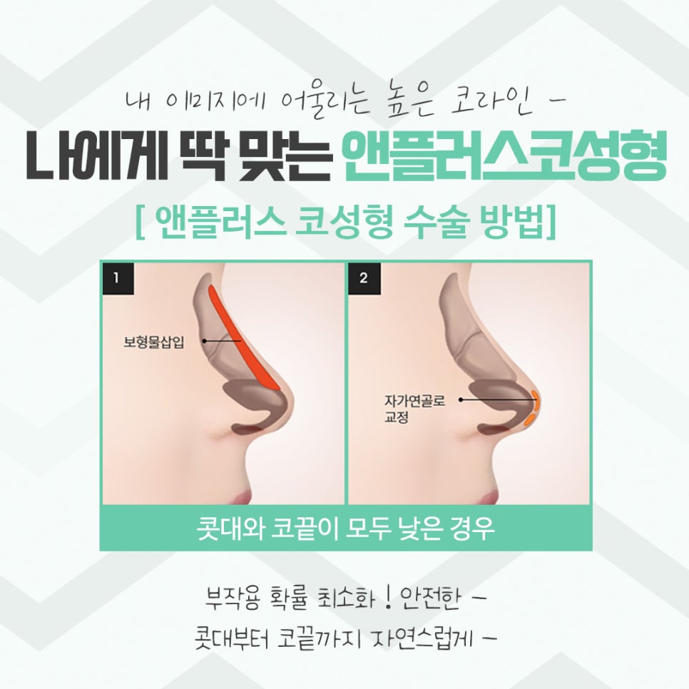 코성형후기 자연스러운 코라인으로 관련 이미지 8
