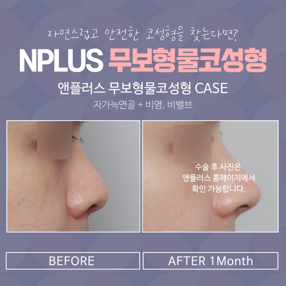 무보형물코수술 자연스러운 코 라인을 원한다면! 관련 이미지 14