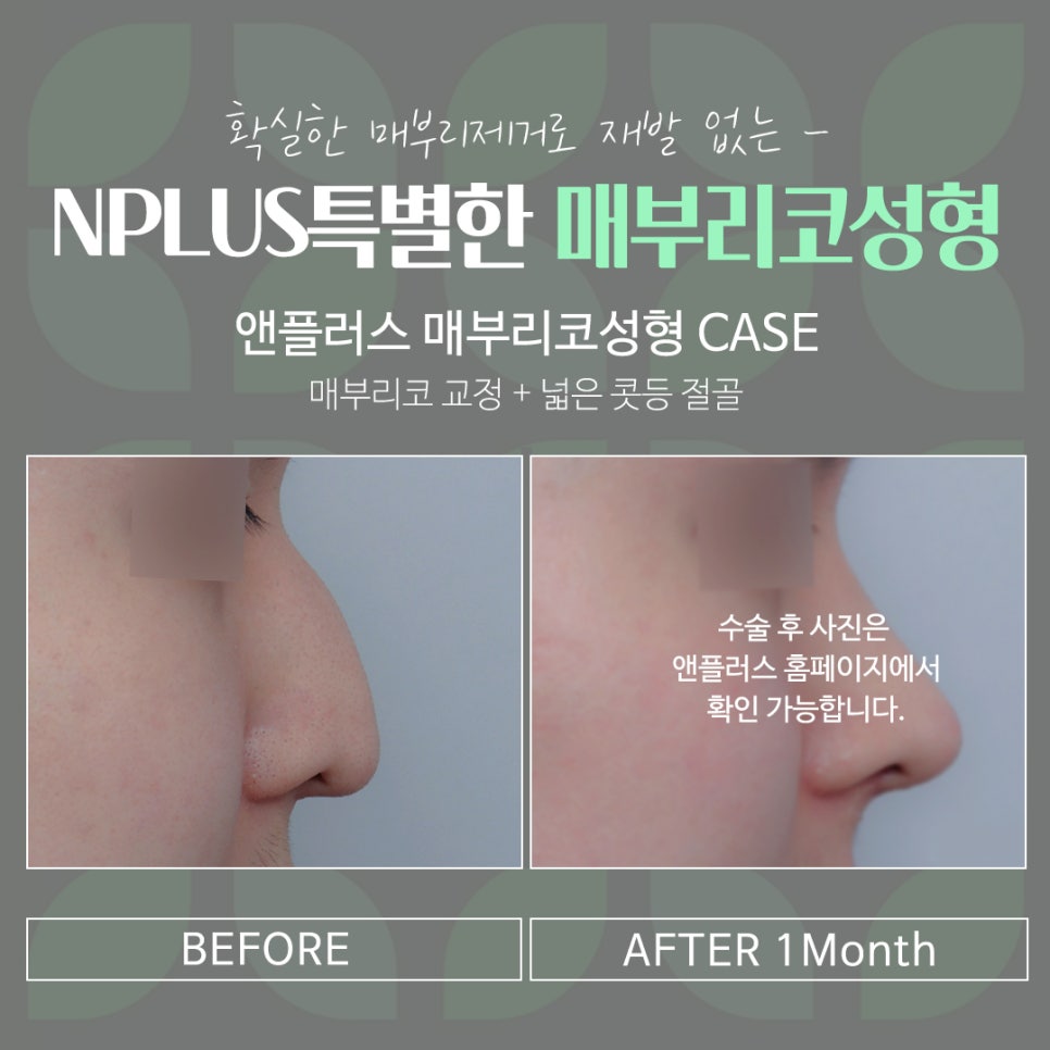 Septoplasty and Hump Nose Surgery Review, Considering Function Too image 6