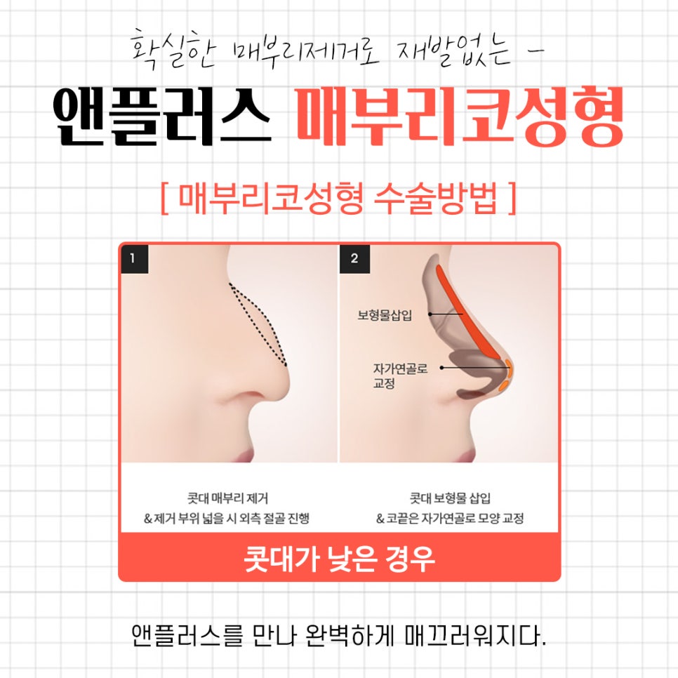 A Complete Guide to the Causes of a Hump Nose and Surgical Methods image 8