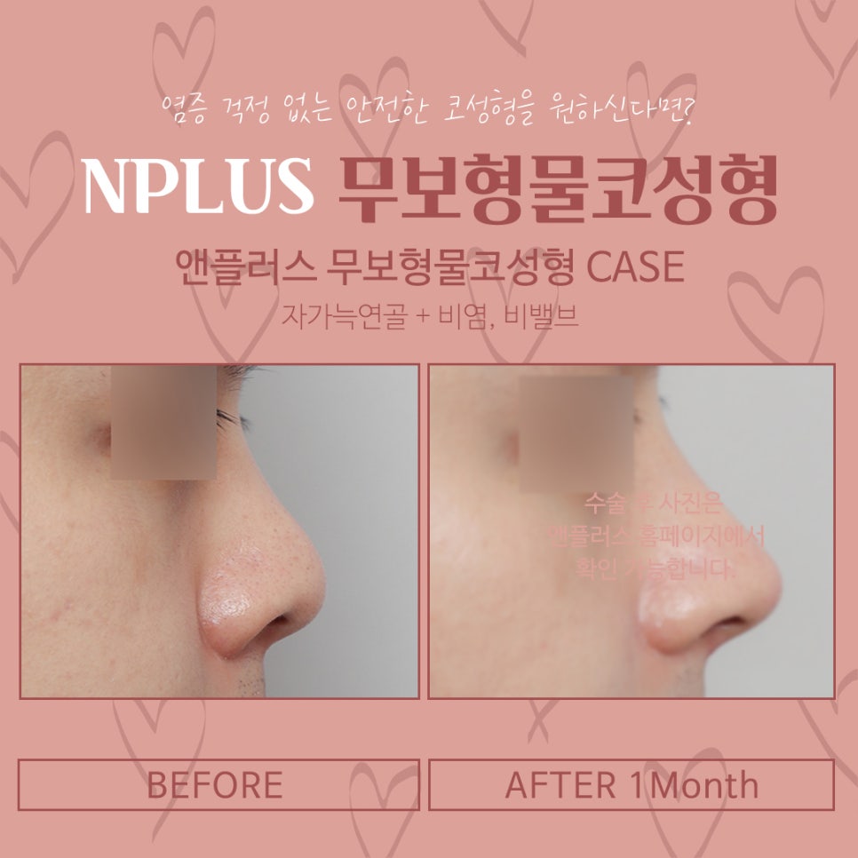 무보형물코수술후기 자연스러운 코라인으로 관련 이미지 12