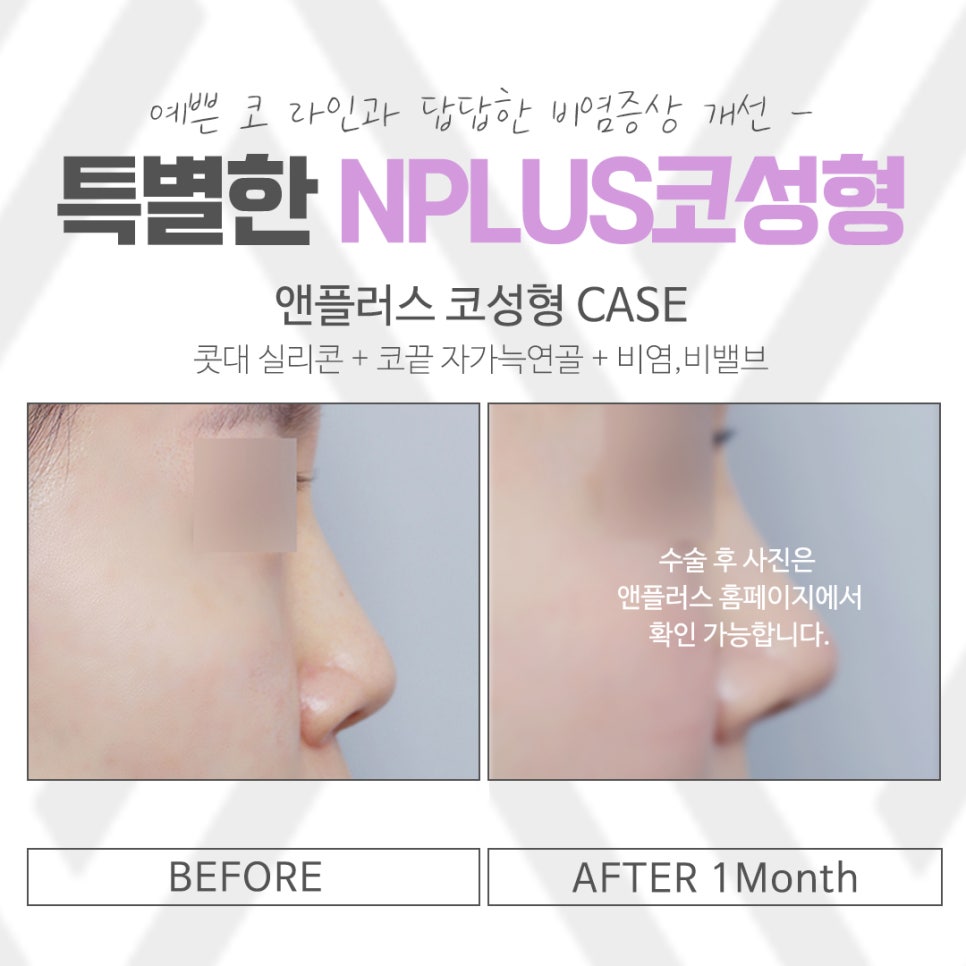 낮은코성형에 대한 정보를 찾아본다면 관련 이미지 12