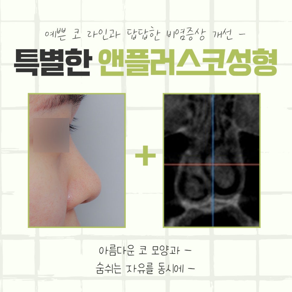 강남코성형에 대해 자세하게 알아보고 관련 이미지 3