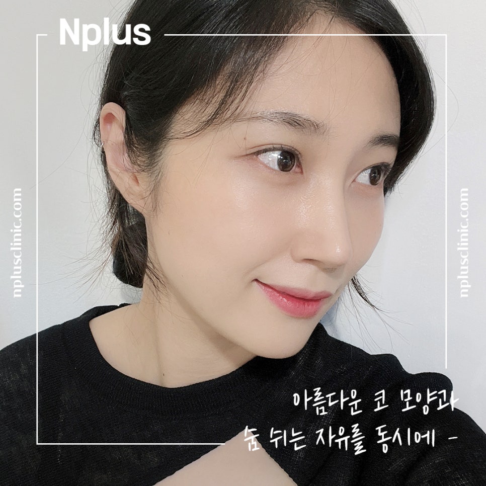 Before and After Nose Surgery: Looking into It Carefully image 8