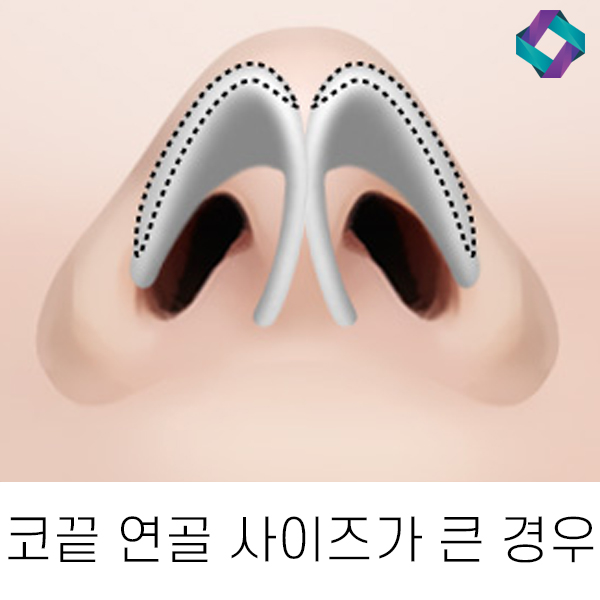 복코성형 유형에 따라 다른 수술방법 관련 이미지 4