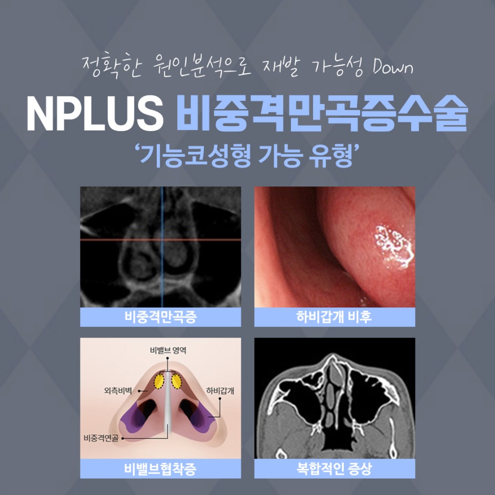 비중격코성형 정확한 원인 파악으로 관련 이미지 5