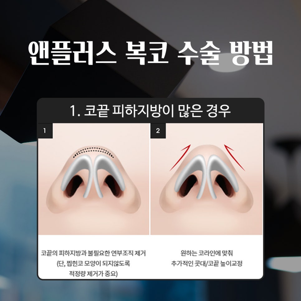 성형하기 힘든 코유형 관련 이미지 9