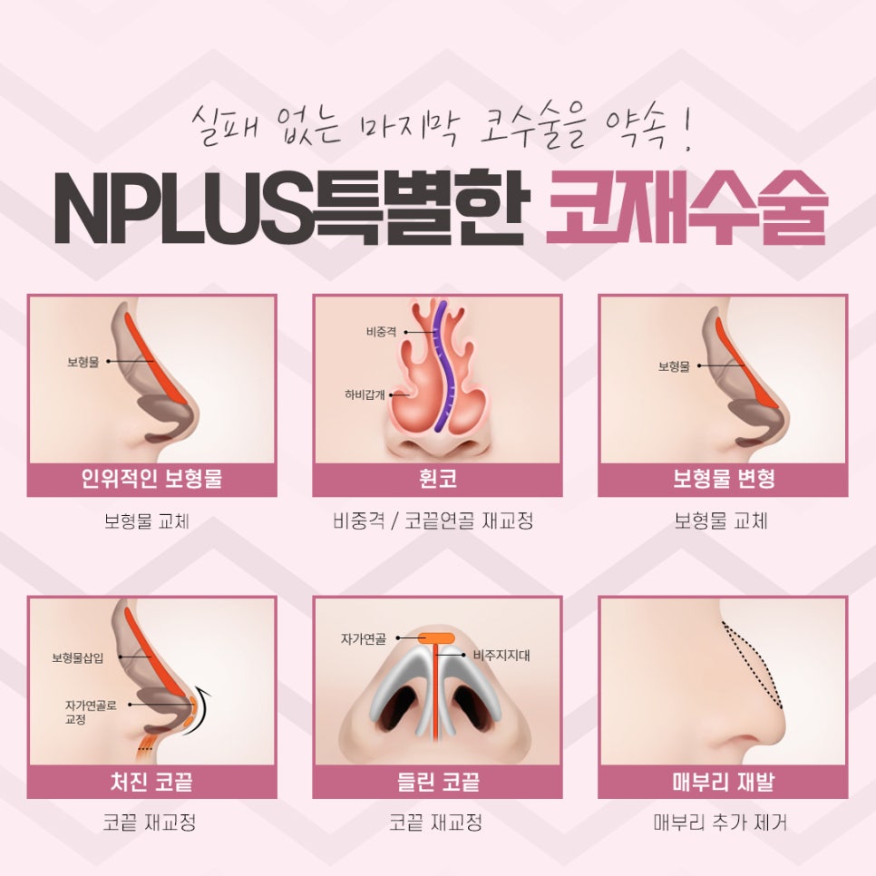 Review of Revision Rhinoplasty: Exploring Various Aspects image 9