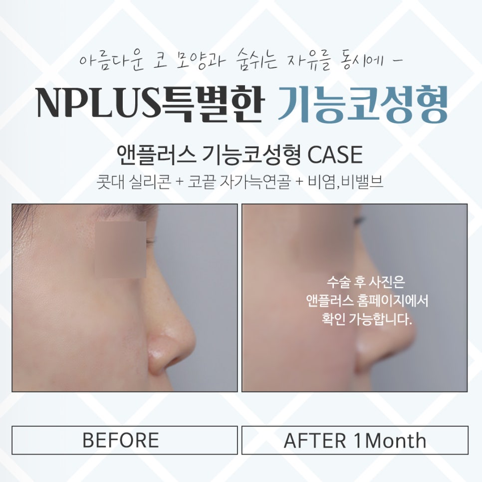 기능코성형후기를 통해 개선된 점 관련 이미지 15