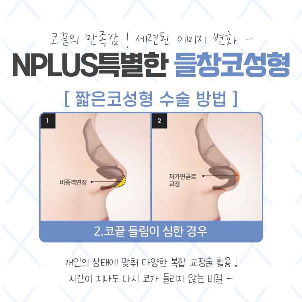 Upturned Nose Surgery for a Harmonious Look image 9