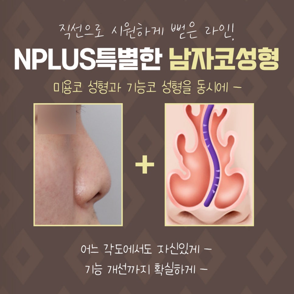 Achieving a Clear Line in Male Rhinoplasty Before and After image 13