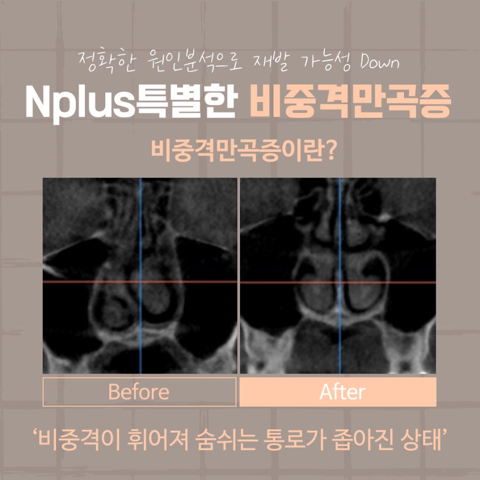 비중격만곡증수술후기 신중하게 고려하여 관련 이미지 5