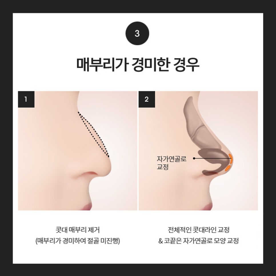 Hooked Nose Before-and-After Photos for a Softer Look image 8